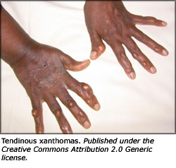 Picture of hands with xanthomas.