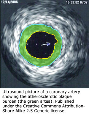 Lower cholesterol naturally: Ultrasound of plaque in an artery.
