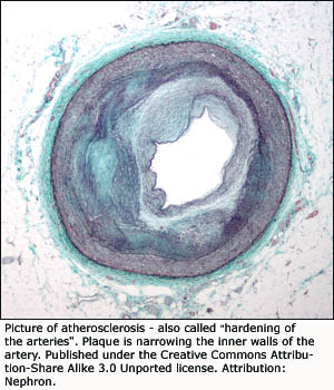Atherosclerosis: a narrowing of the arteries caused by cholesterol among other things.
